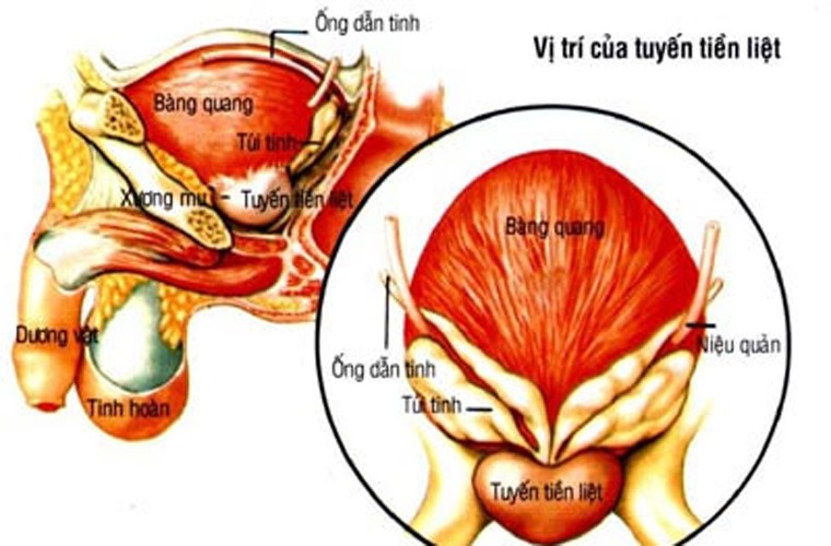 Hiện nguyên nhân chính xác gây ung thư tuyến tiền liệt vẫn còn là một bí ẩn. Tuy vậy, các nhà khoa học cho rằng những yếu tố dưới đây có ảnh hưởng không nhỏ đến sự hình thành căn bệnh.